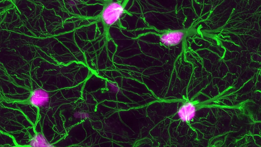 Científicos estadounidenses identifican la fuente en el cerebro que ‘alimenta’ la demencia
