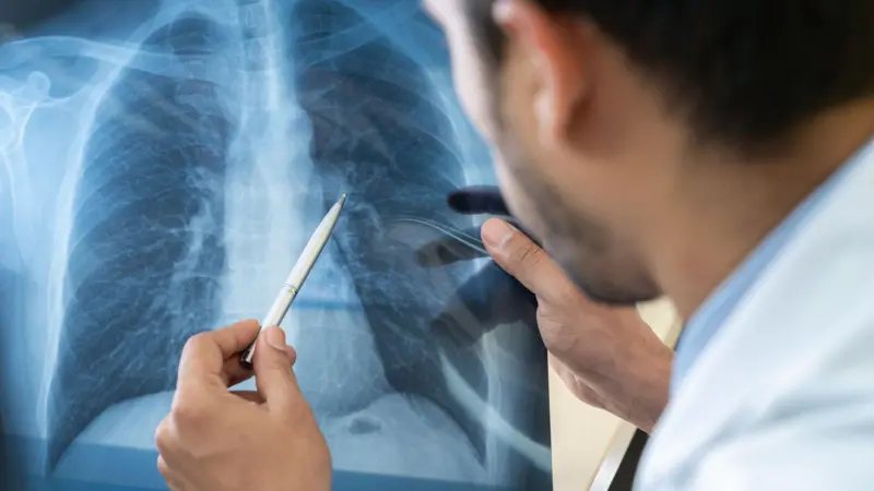 Retos en la prevención del cáncer de pulmón