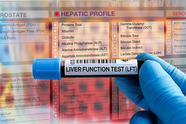 Nuevo análisis sanguíneo detecta enfermedad hepática oculta relacionada con alcohol – diagnostico-molecular